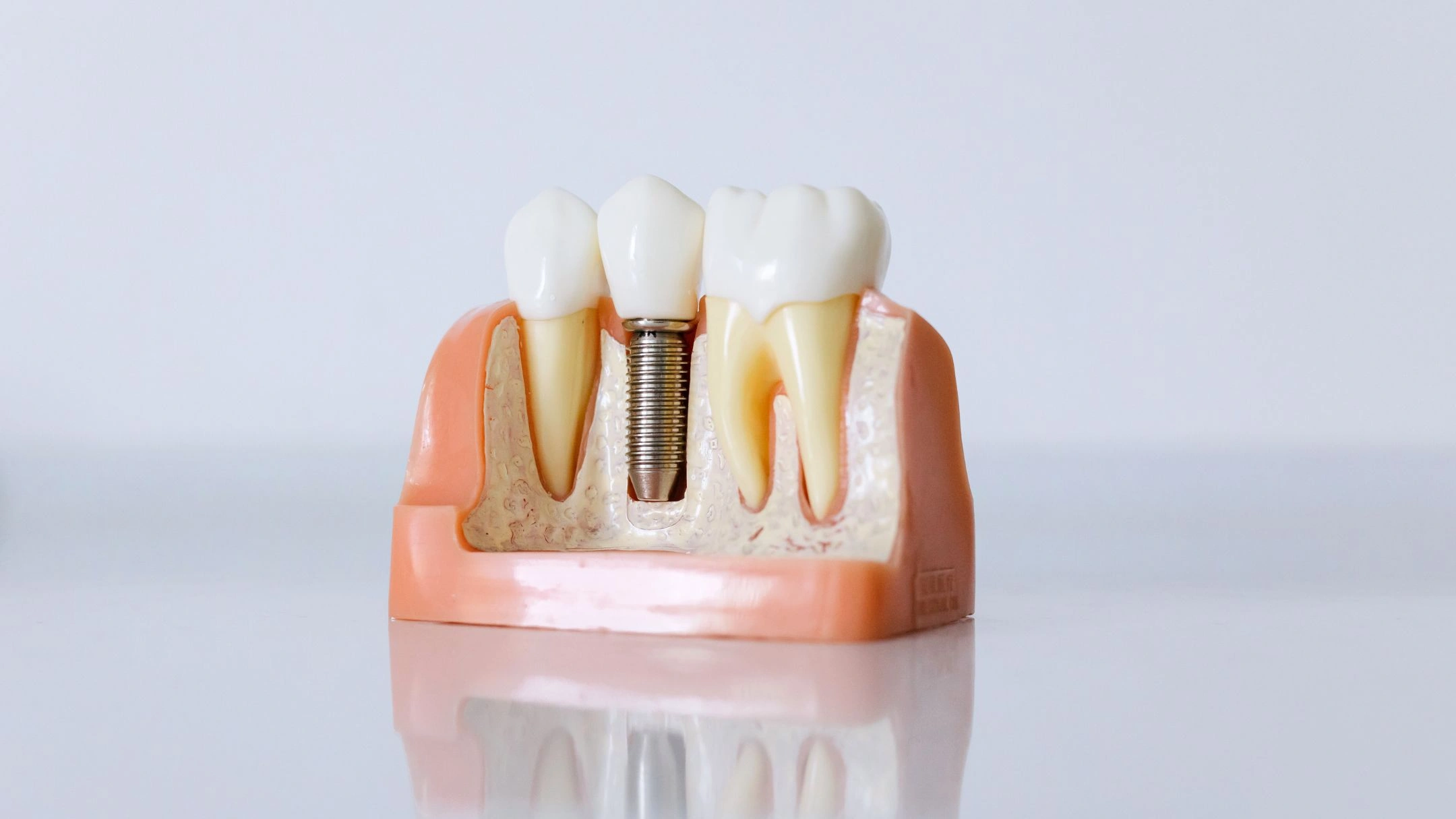 Impianti dentali Padova - come avere il sorriso di quando eri giovane