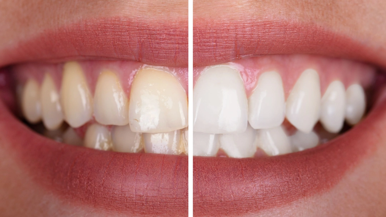 Macchie sui denti - cosa c’è da sapere per intervenire nel modo più corretto
